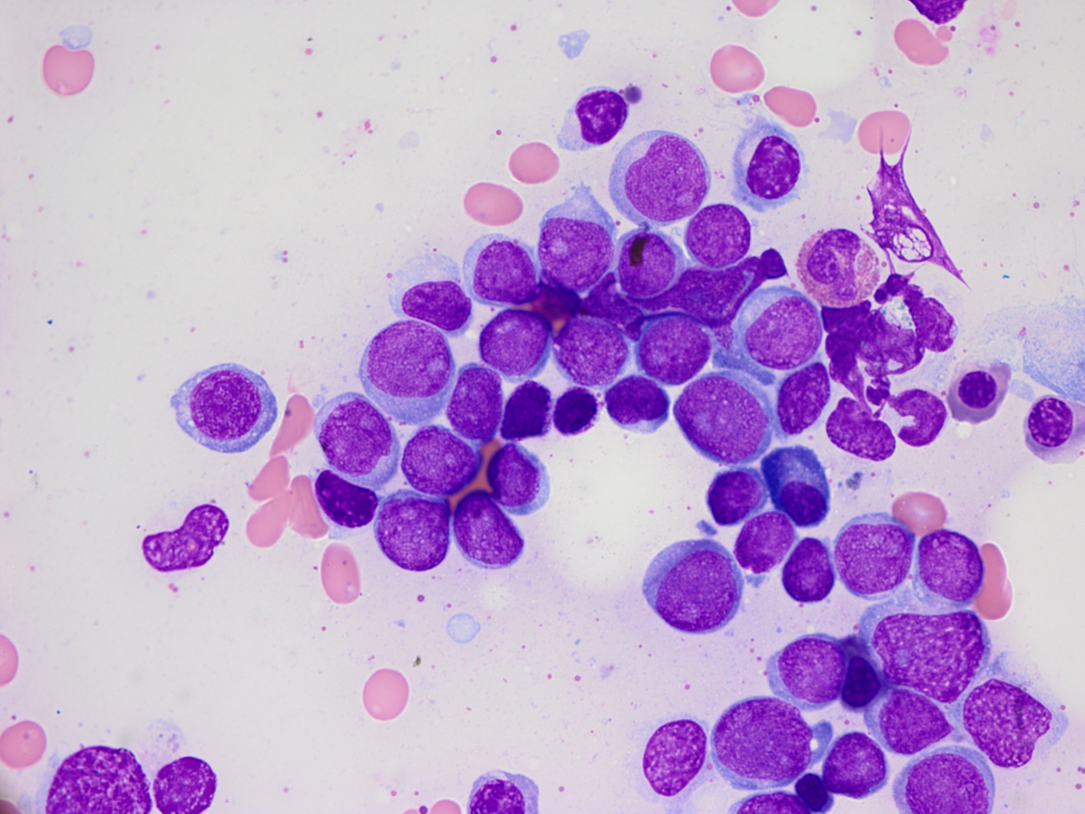 Bone marrow aspirate smear from initial diagnostic marrow